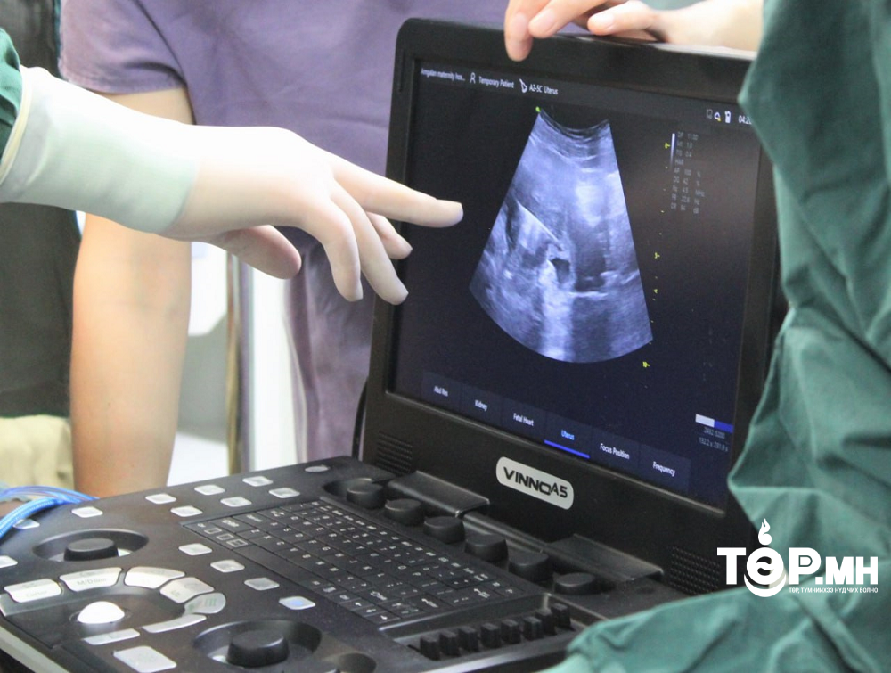 Умайн хоргүй хавдрыг түлэх эмчилгээг амжилттай нутагшуулж байна