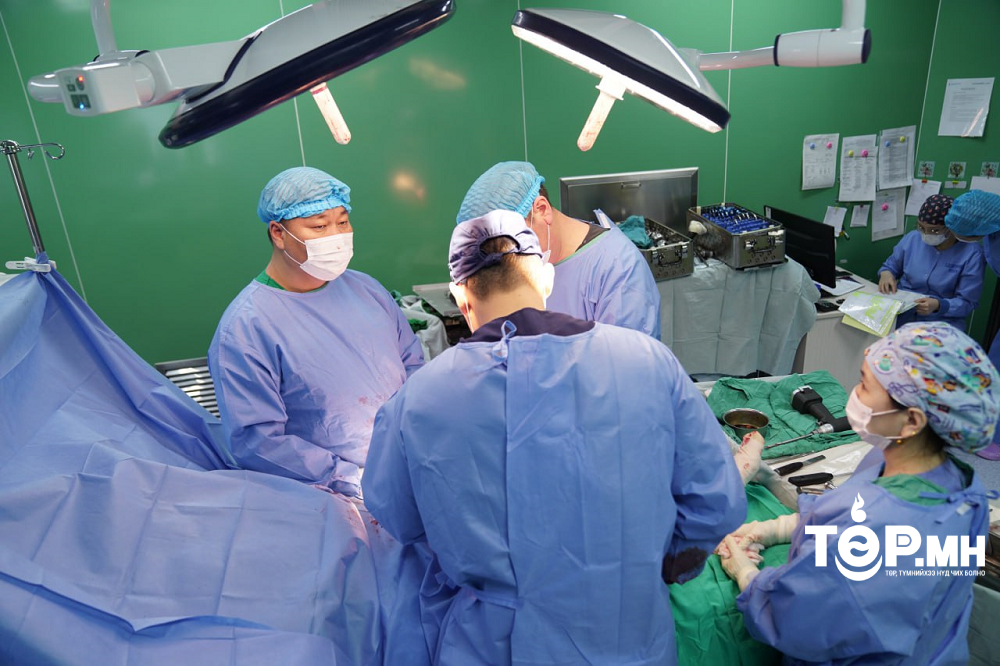 Монголд анх удаа дээд мөчний ясны том хэмжээтэй хавдрын хиймэл үе суулгах мэс заслыг амжилттай хийлээ