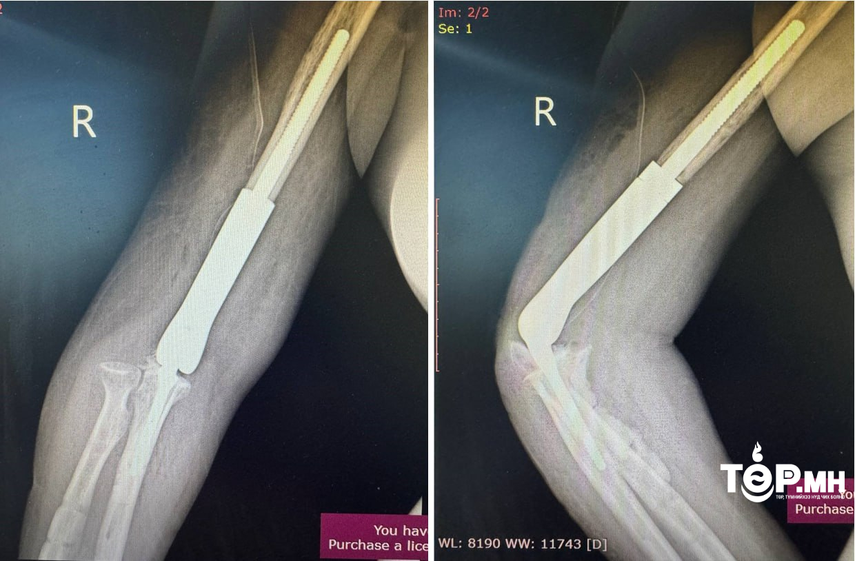 ГССҮТ: Эмч нар тохойн үе, атгаал ясны дутмагшлыг нийлмэл хиймэл үеэр солих мэс заслыг нэвтрүүллээ