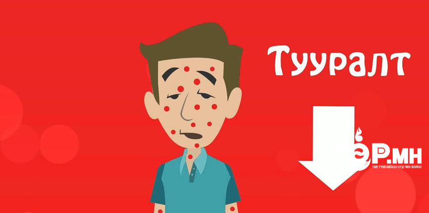 Баян-Өлгий аймагт улаанбурхан өвчний сэжигтэй тохиолдол бүртгэгджээ