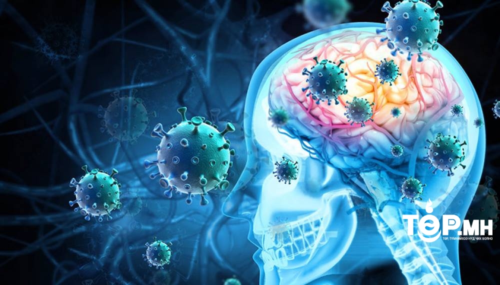 Менингит, миелингүйтэл өвчний тусламж, үйлчилгээний 85 хувийг ЭМД-ын сангаас хөнгөлнө